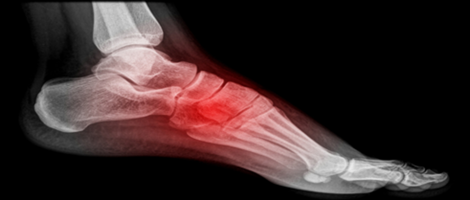 Stress Fractures – The Foot Guy | David Allison, D. Ch.